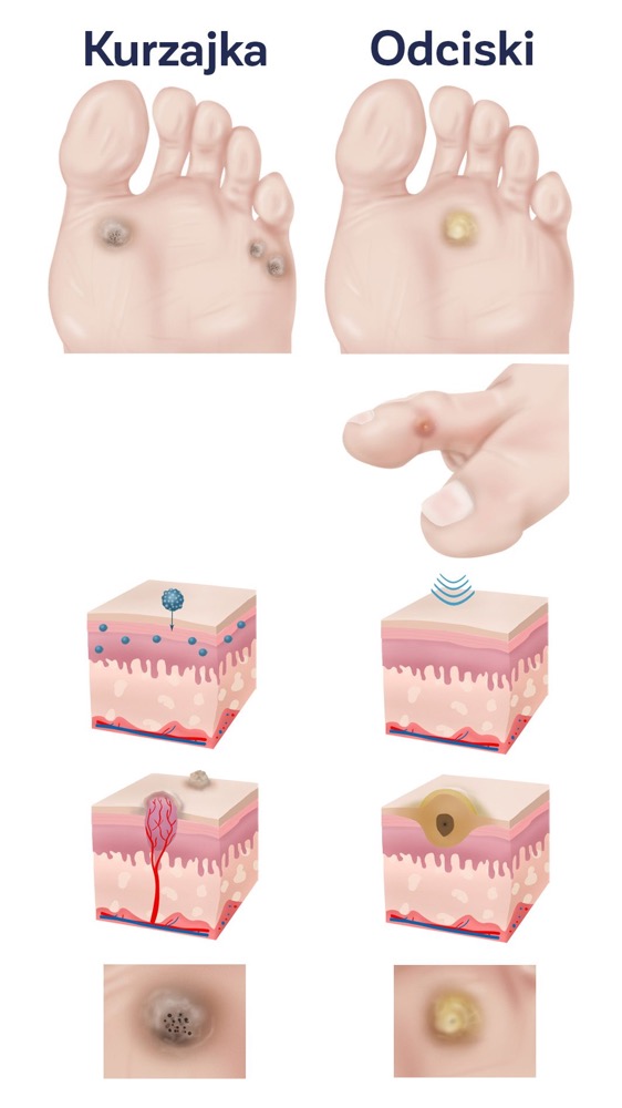 infografika z porównaniem kurzajki i odcisku