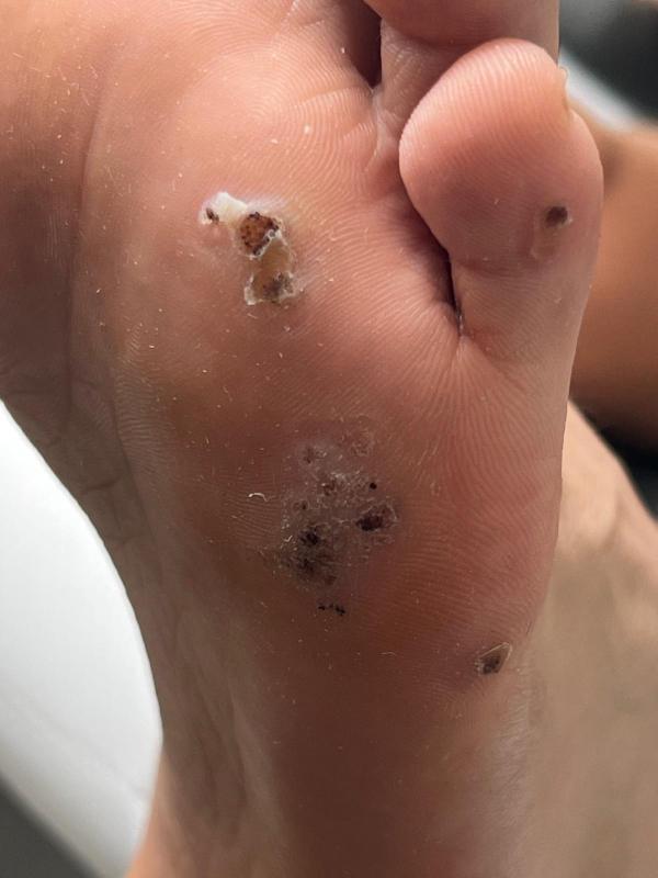 stopa z wieloma kurzajkami